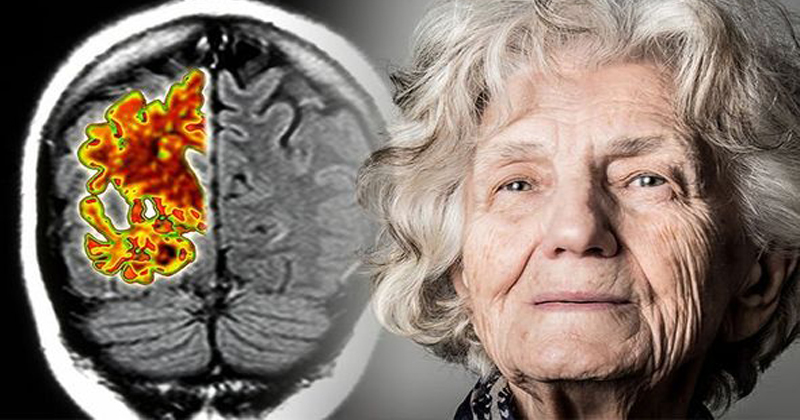 Beynin yaşlanması yavaşlatılabilir mi?